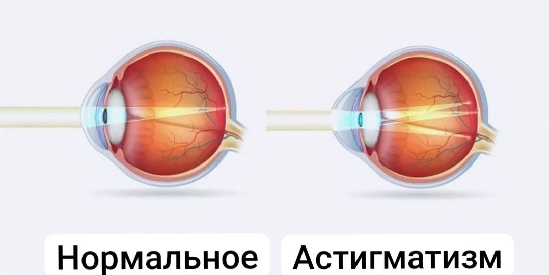 Астигматизм для родителей, как для студентов