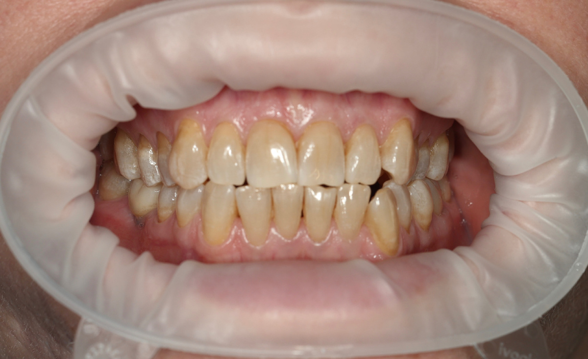 Состояние до - невоспалительные рецессии