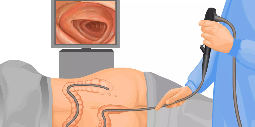 ВИДЫ КОЛИТА: Всё, что Вам Следует Знать (подробный обзор)