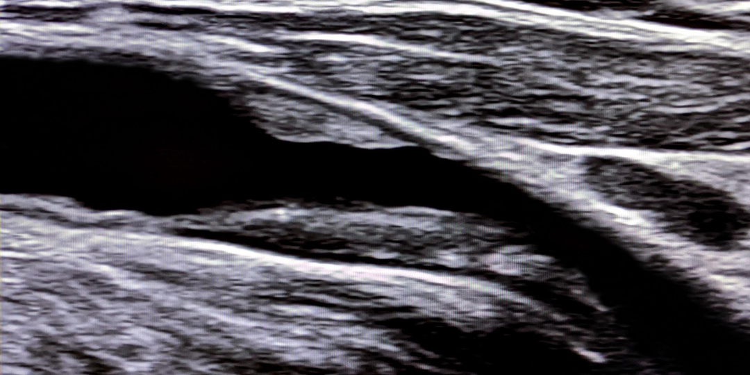 Нашли бляшку со стенозом 30%. Это опасно?