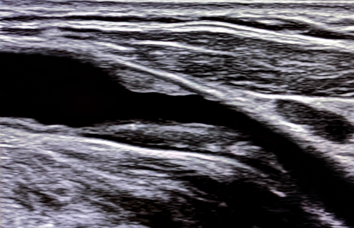 Здесь бляшка создает стеноз побольше, чем 30%