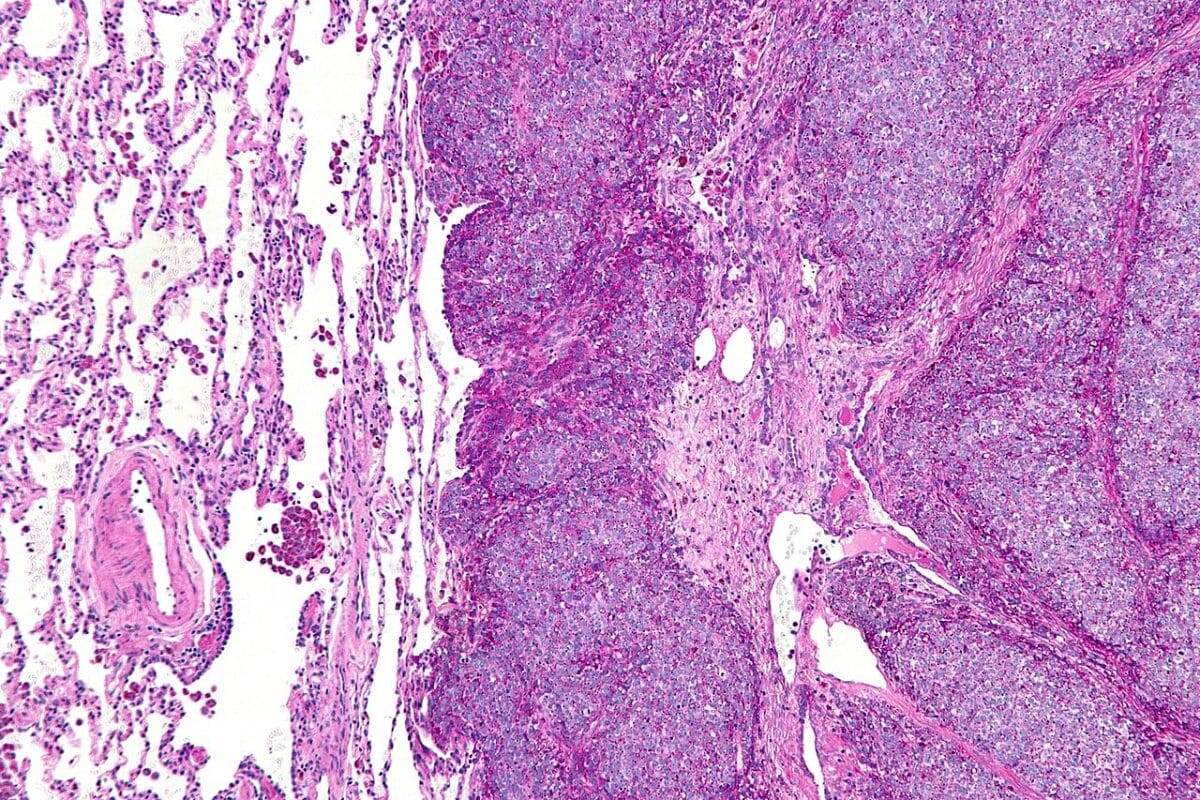    Микрография метастатической саркомы Юинга (справа на изображении) в нормальном легком (слева на изображении) / © Nephron, Wikipedia
