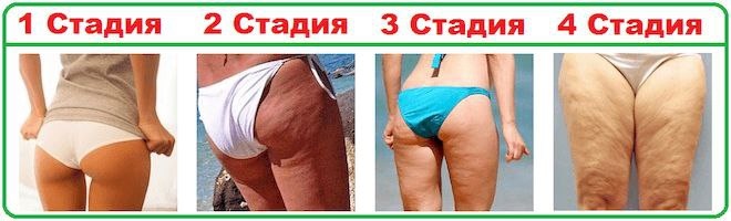 Стадии целлюлита