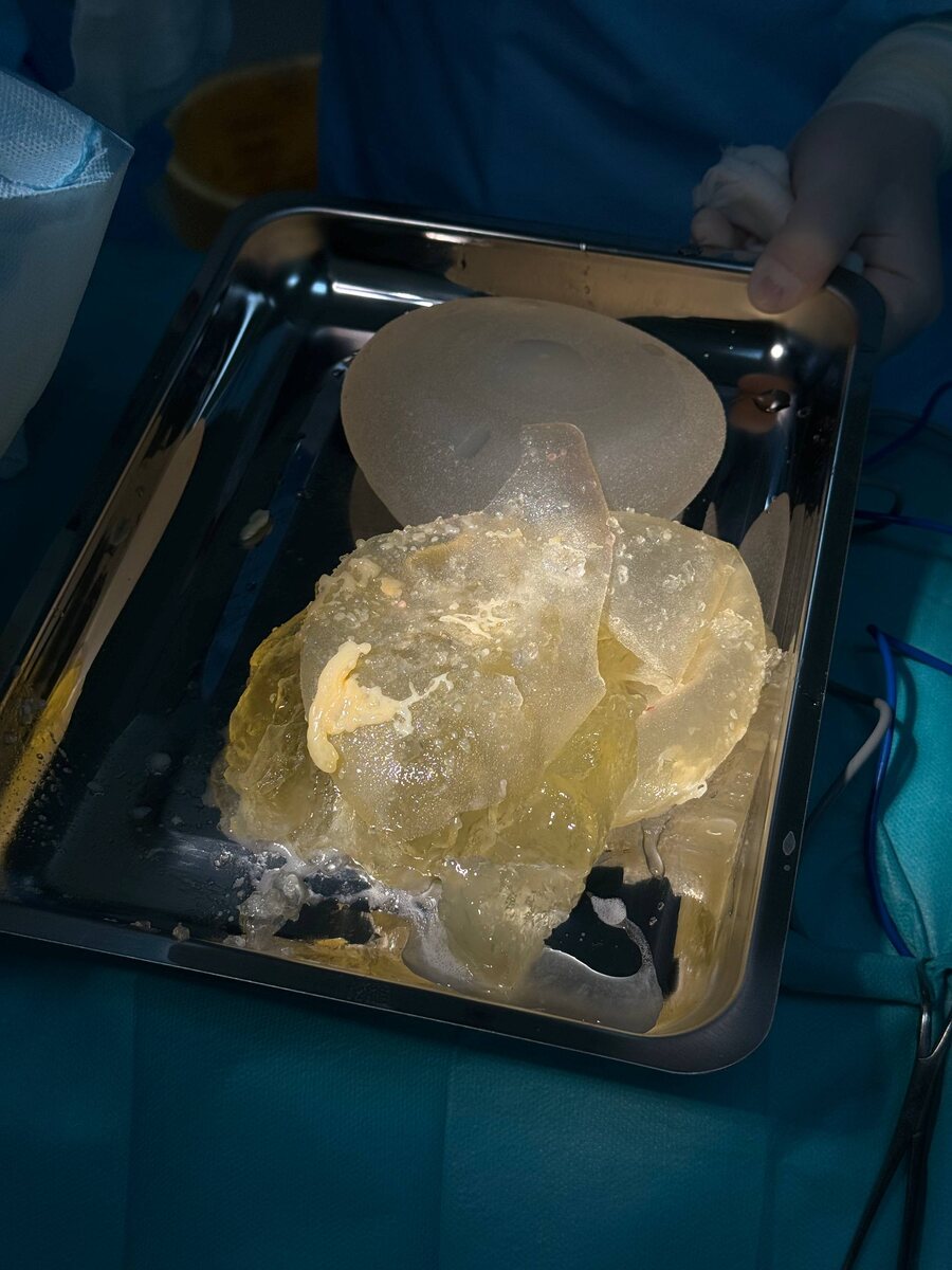 имплант который нам удалось изъять во время операции 