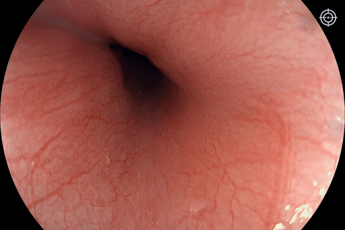 Рис. 1 - Пищевод