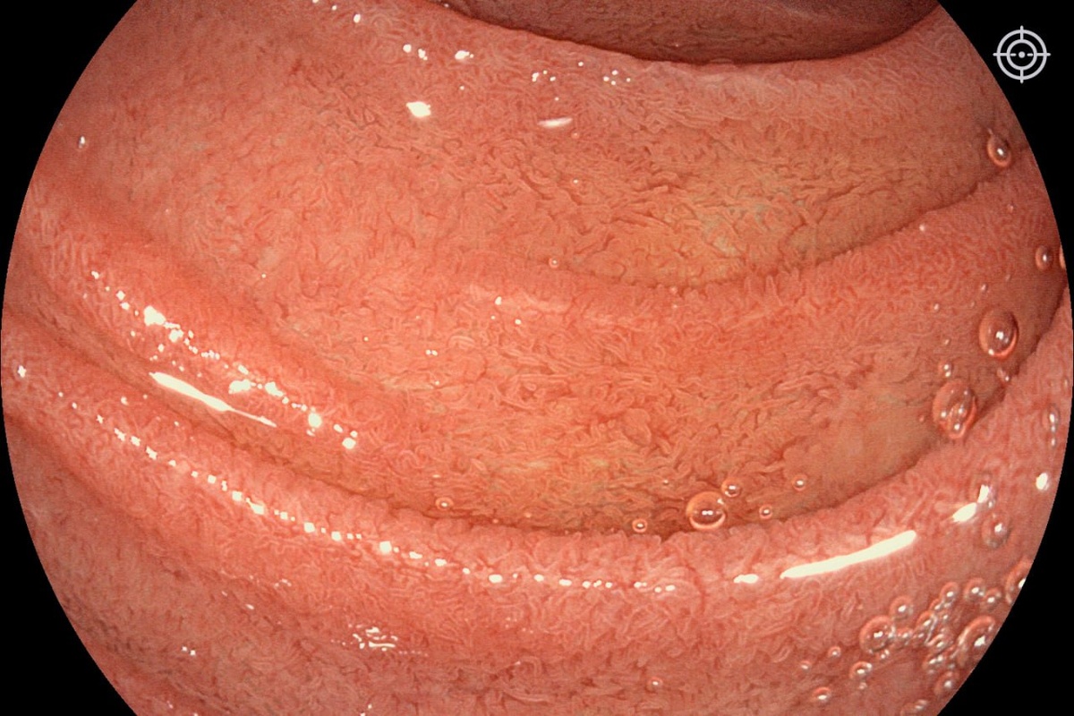 Ворсинки слизистой двенадцатиперстной кишки в норме