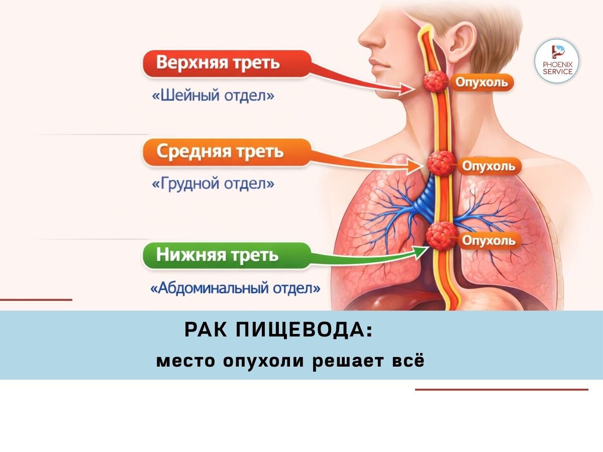 Рак пищевода: схема расположения опухоли в верхней, средней и нижней трети пищевода