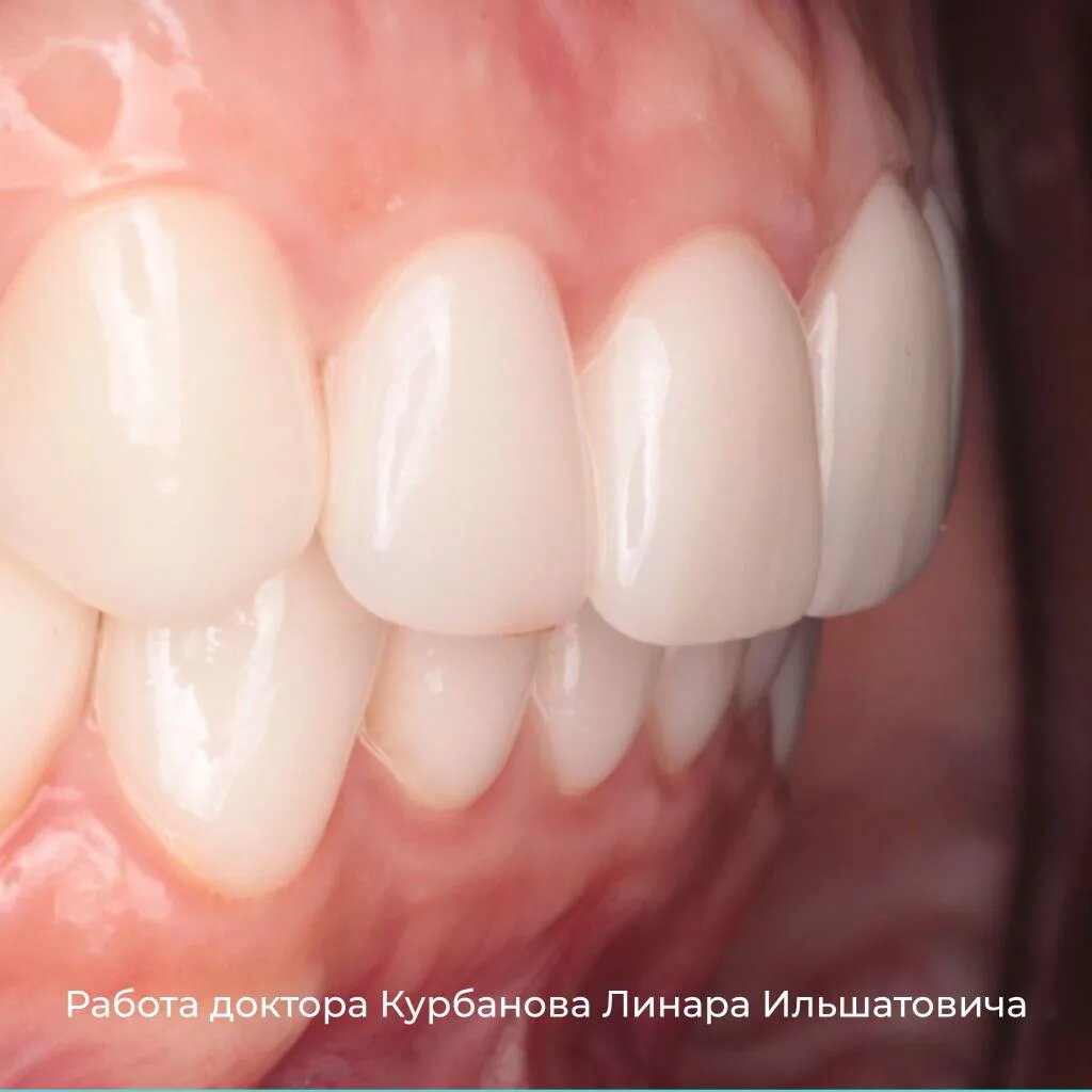 Виниры работа доктора Курбанова Л.И.