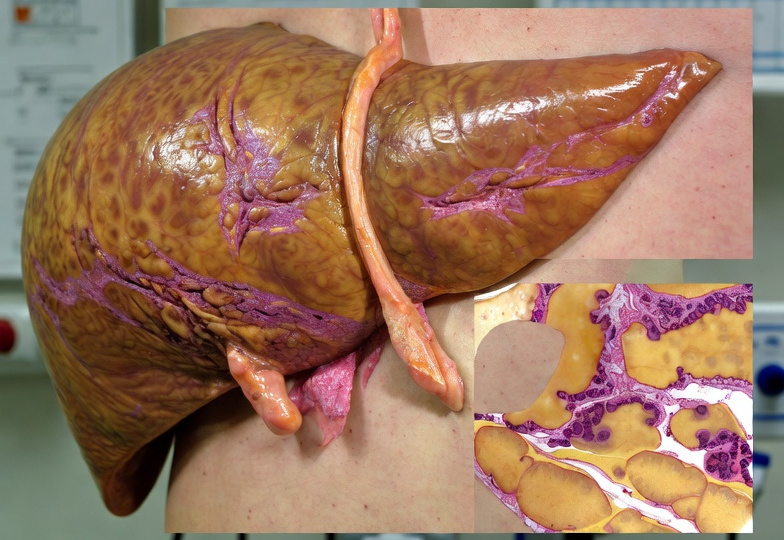 Как понять, что печень уже повреждена? (симптомы)