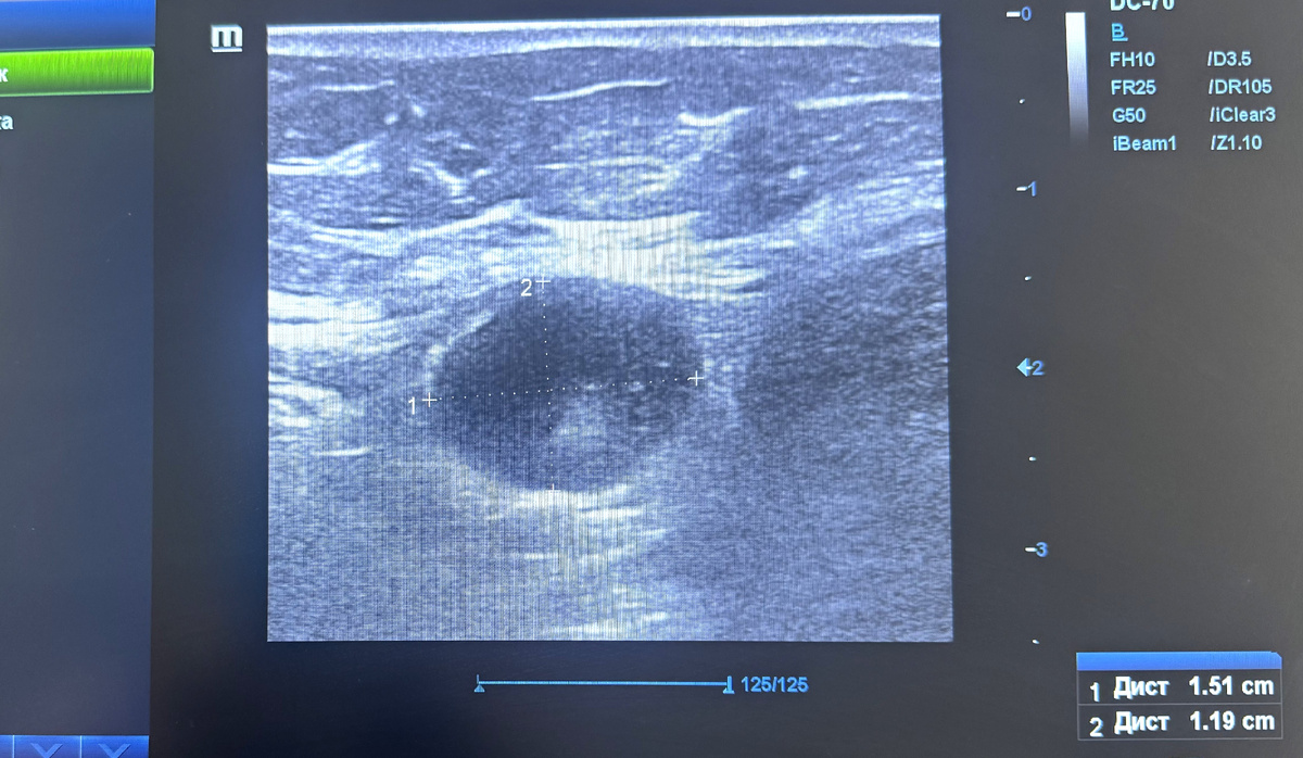 Так по УЗИ выглядит типичный метастатически измененный лимфоузел