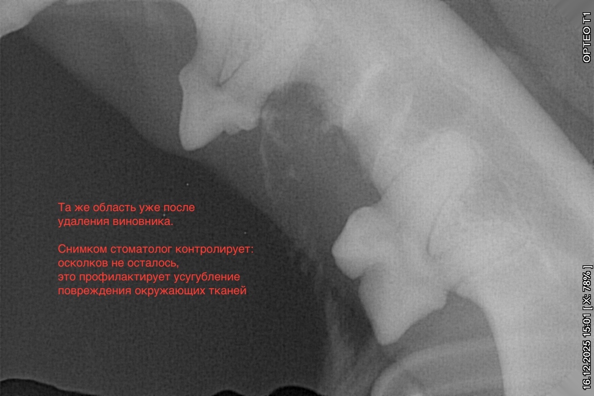 Пример той же зоны интереса, но уже после удаления зуба