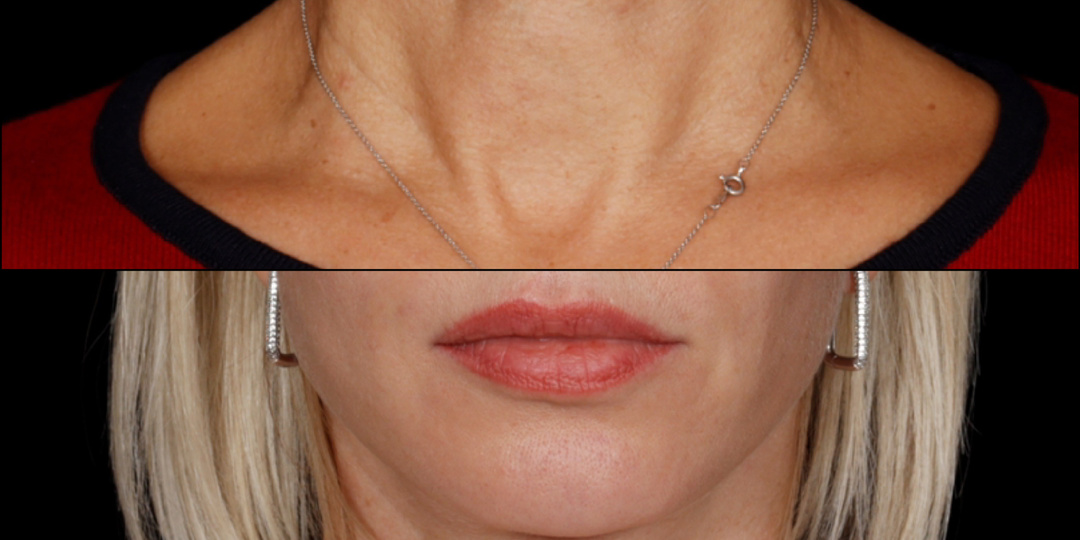 Дряблая шея. Кольца Венеры. Как убрать?