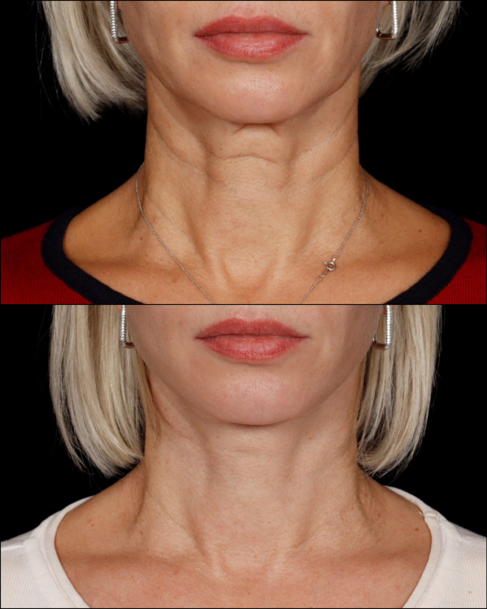 Моя пациентка после подтяжки лица и шеи. Имеются противопоказания. Необходима консультация со специалистом.