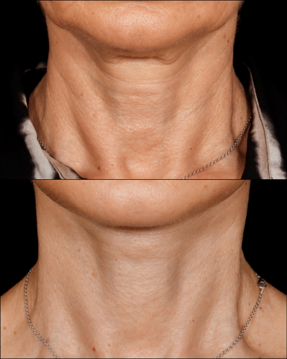 Моя пациентка после подтяжки лица и шеи. Имеются противопоказания. Необходима консультация со специалистом.