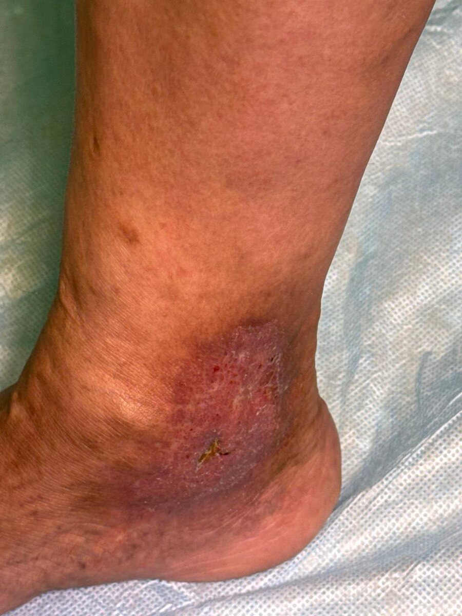 Нога пациентки до операции, потемнение кожи в области голеностопа и незажившая язва