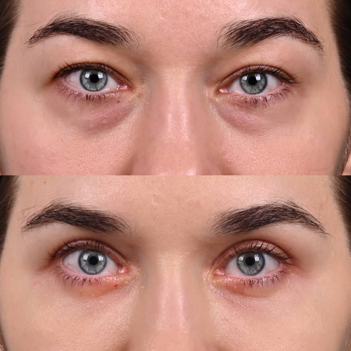 Объемное омоложение век. Фото с сайта хирурга Д.Р. Гришкяна. Имеются противопоказания, требуется консультация специалиста.