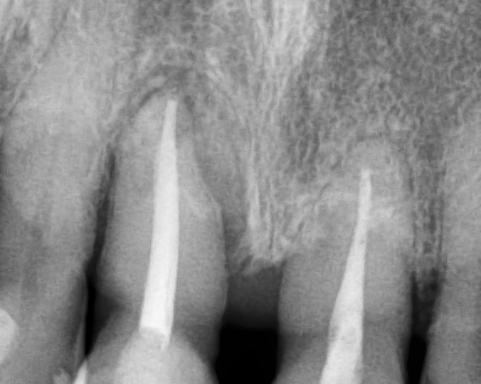 Перелечивание каналов перед удалением - зачем лечить безнадёжный зуб и как это поможет имплантации