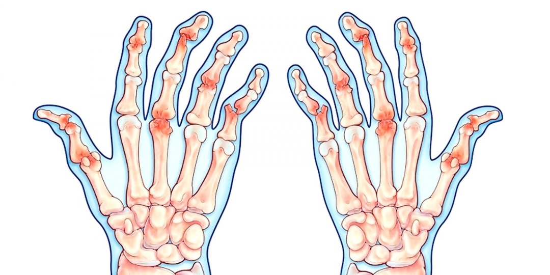 Псориаз и суставы — признаки псориатического артрита