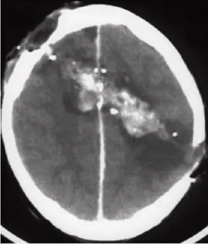 КТ пациента с диаметральным пулевым ранением черепа и головного мозга. На момент снимка - эпилепсия не его главная проблема. Но в будущем она также у него возникла. 