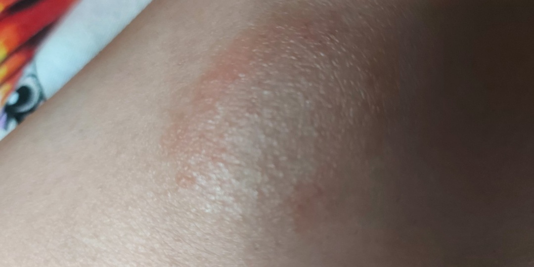 Этот симптом на коже часто появляется раньше других