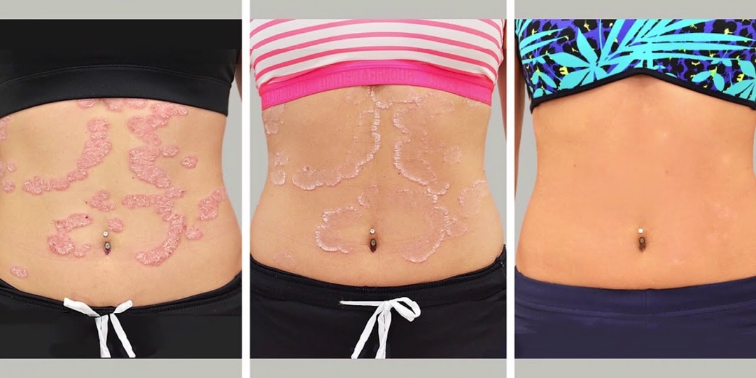 Псориаз начальная стадия — первые симптомы