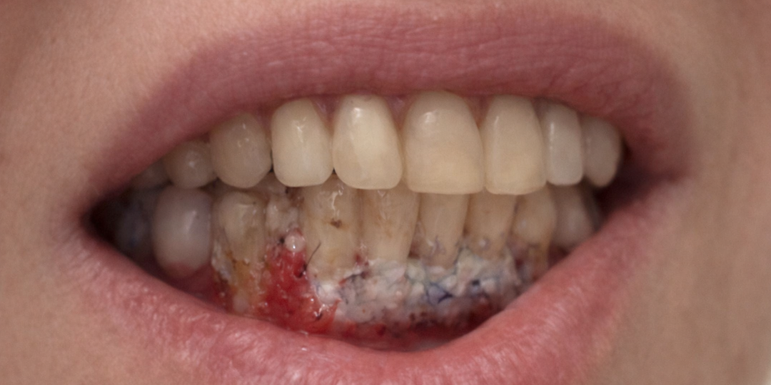 Некроз трансплантата после пластики десны