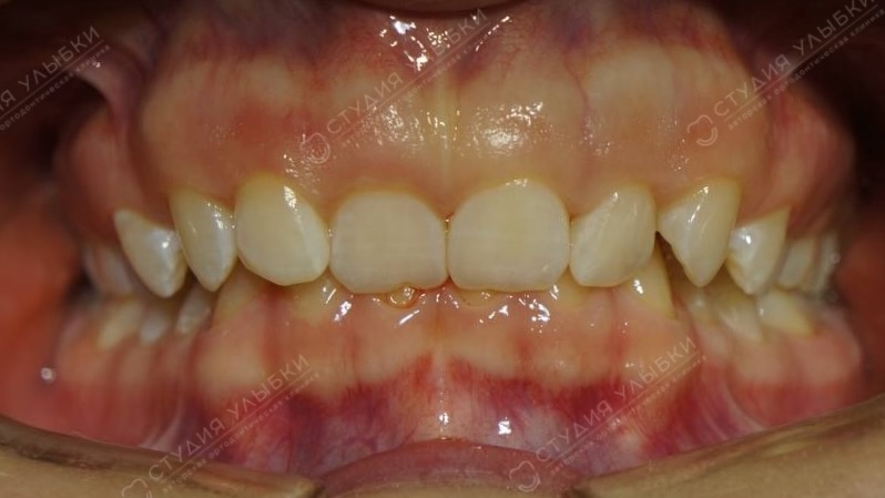 Глубокий прикус