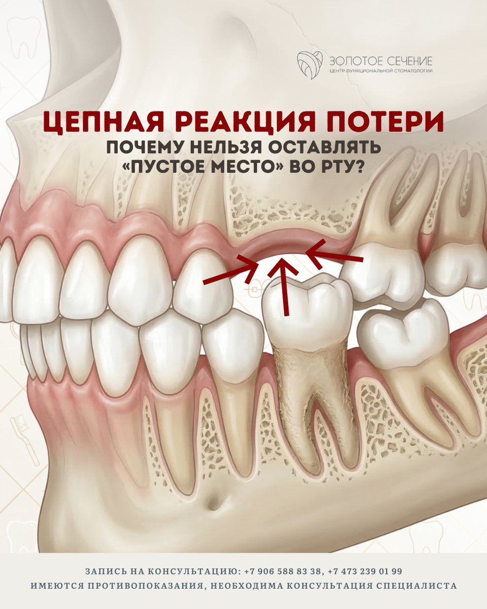 На изображении: деформация прикуса (Феномен Попова-Годона)
Зубы-соседи теряют опору и начинают наклоняться в сторону дефекта, а зуб-антагонист с противоположной челюсти «выдвигается» в пустоту. Это создает блоки при жевании, которые разрушают эмаль здоровых зубов и делают невозможным качественное протезирование в будущем без предварительного брекет-лечения.