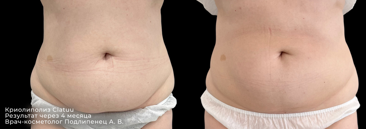 Фото до и после процедуры криолиполиза в клинике косметологии GEN87