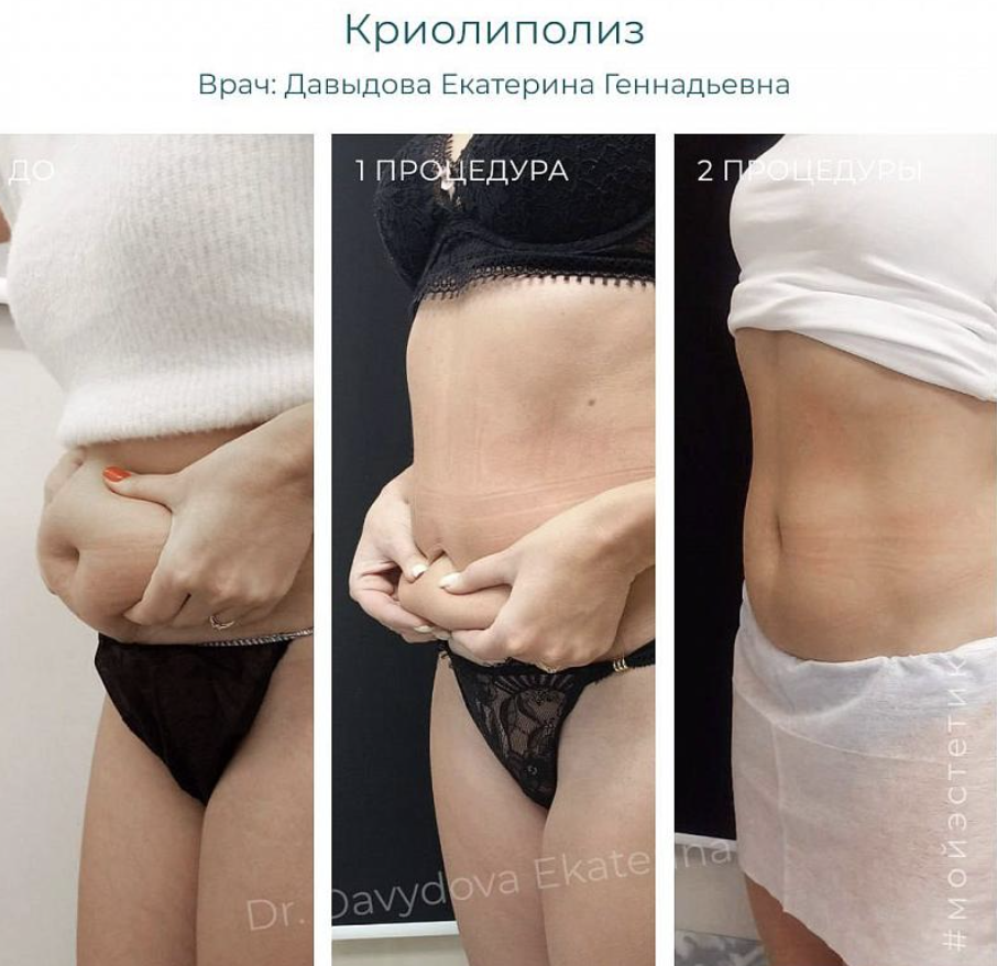 Результат криолиполиза (фото принадлежит Давыдовой Е.К.)