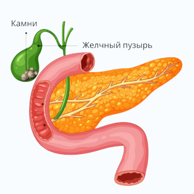 Желчнокаменная болезнь (ЖКБ)