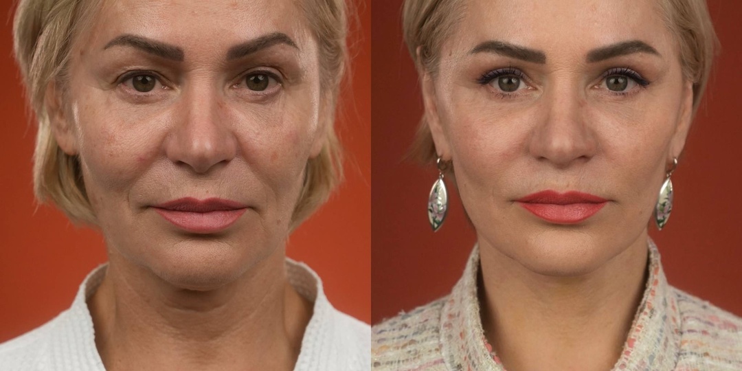 5,5 месяцев после фейслифтинга, верхней блефаропластики