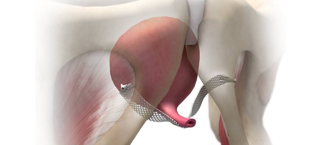Схема фиксации слинговой петли при коррекции стрессового недержании мочи