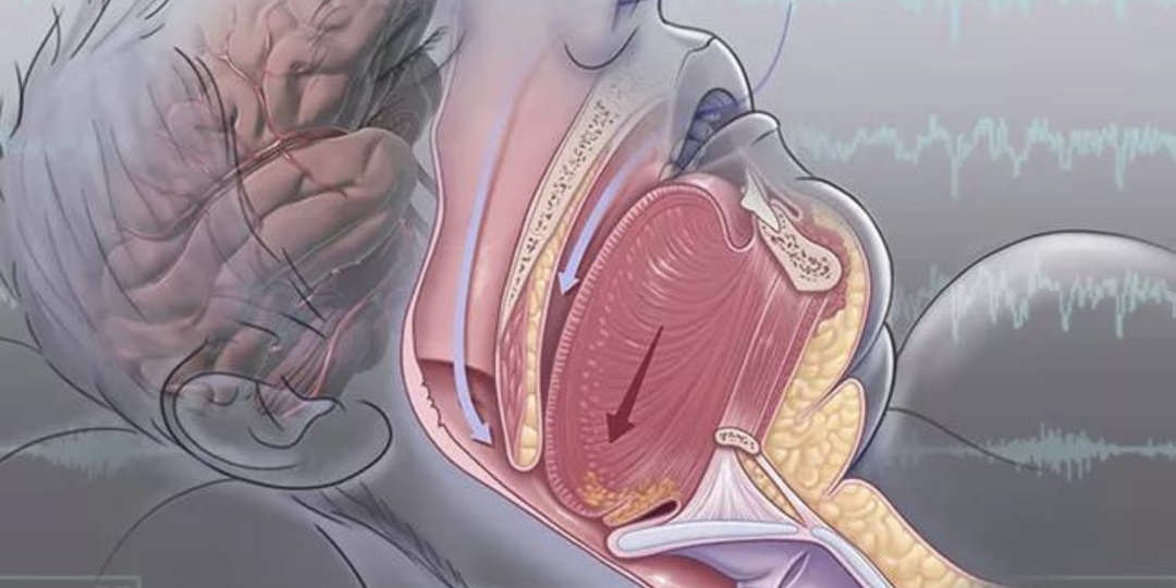 Апноэ во сне увеличивает риск психических расстройств?