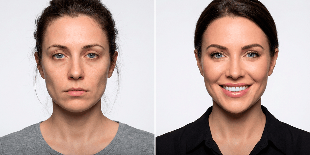 Как меняется лицо после тотальной имплантации: омоложение без пластики после 40