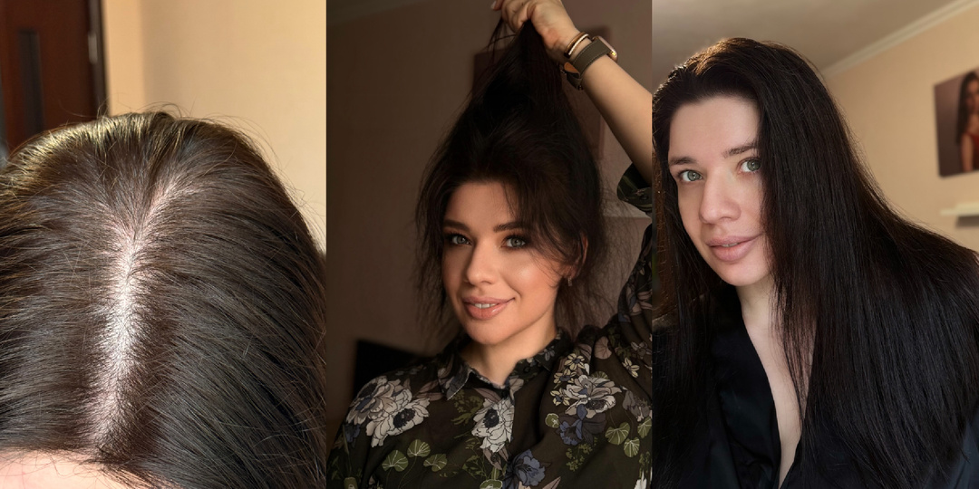 Я лысею. Красные флаги на приеме трихолога. Выпадение волос. Андрогенетическая алопеция. Стресс.