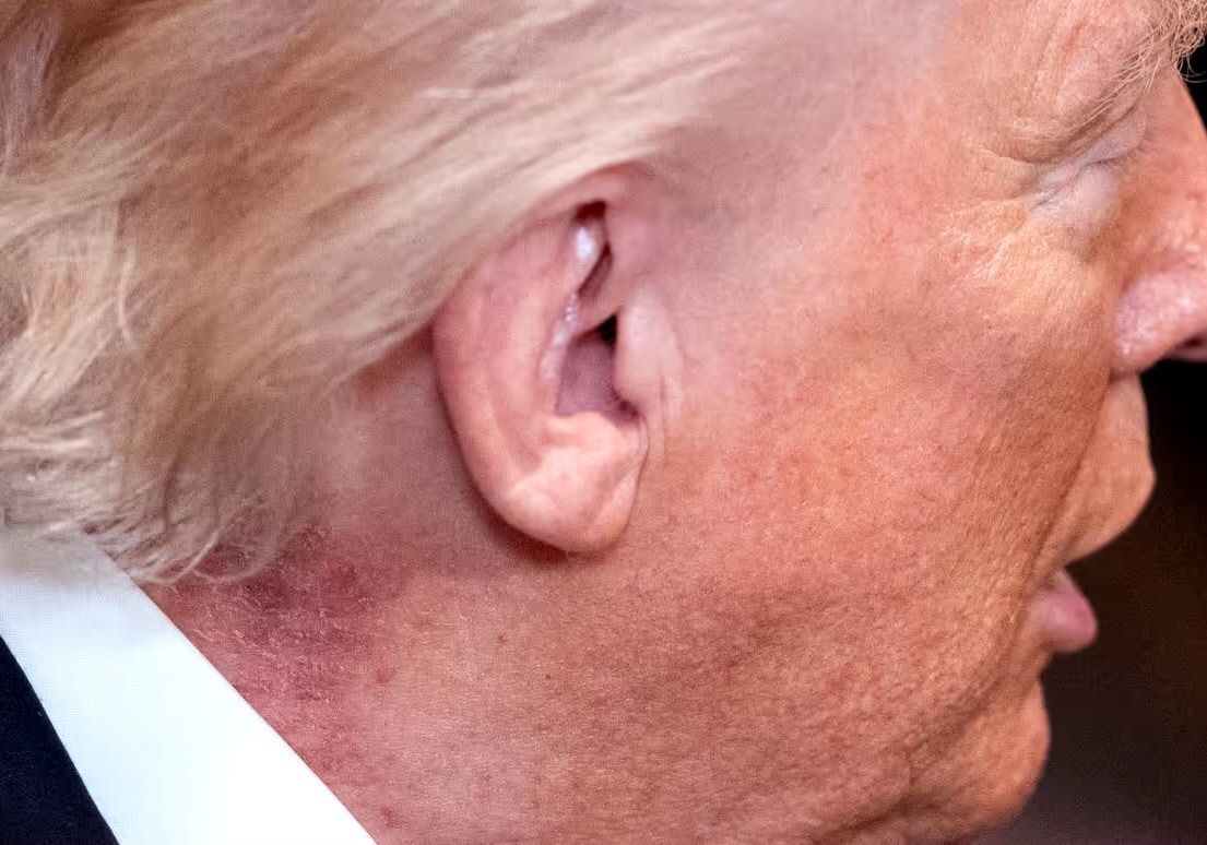 На прошлой неделе у Трампа заметили странную сыпь. (Фото: AP)