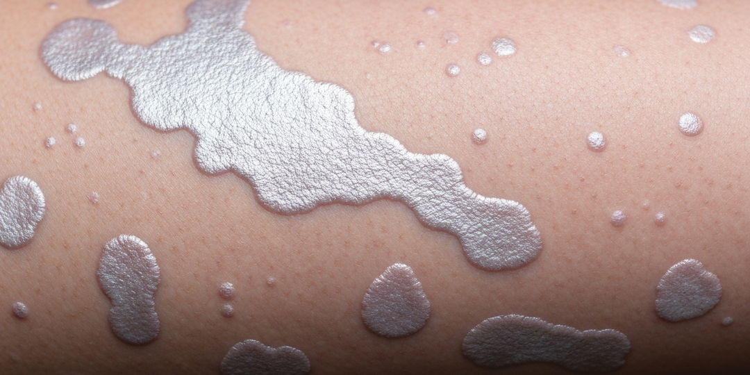 Бляшечный псориаз — наиболее распространённый тип