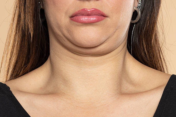 Утолщение подкожно-жировой клетчатки