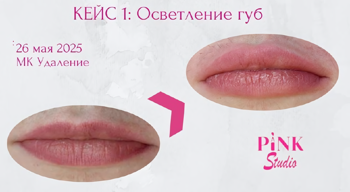 В мае я проводила мастер-класс по удалению перманентного макияжа.