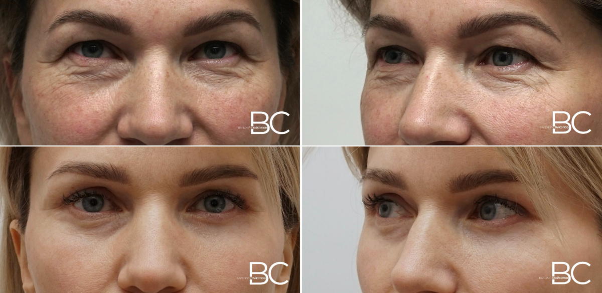 Пластическая операция - периорбитопластика, хирург Стайсупов В.Ю.