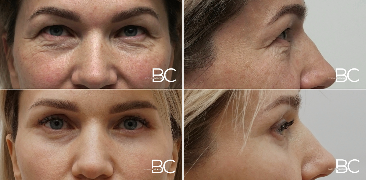 Пластическая операция - периорбитопластика, хирург Стайсупов В.Ю.