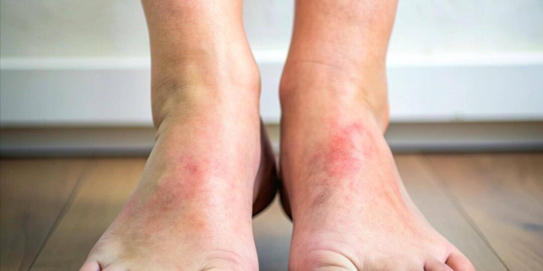 Ноги не болят — значит, все в порядке? Смертельная ловушка диабетической стопы и как в неё не попасть