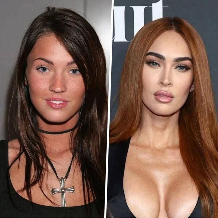 До и после пластики 