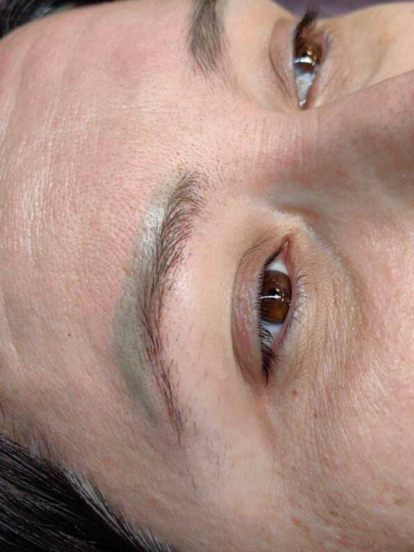 На первом фото — то, с чем она ходила годами. Старая работа, зелёный оттенок, рубцовая ткань над бровью.