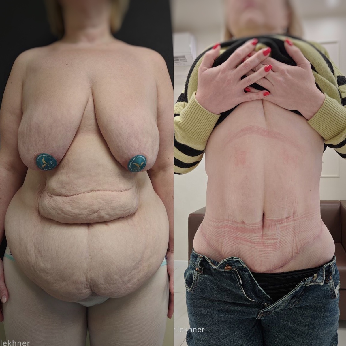 Результат торсопластики в исполнении Лехнера Андрея Владимировича