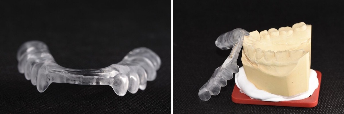 Сплинт - окклюзионная шина