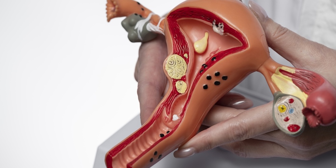 Миому матки без операции не вылечить: правда о консервативных методах и лучшая альтернатива