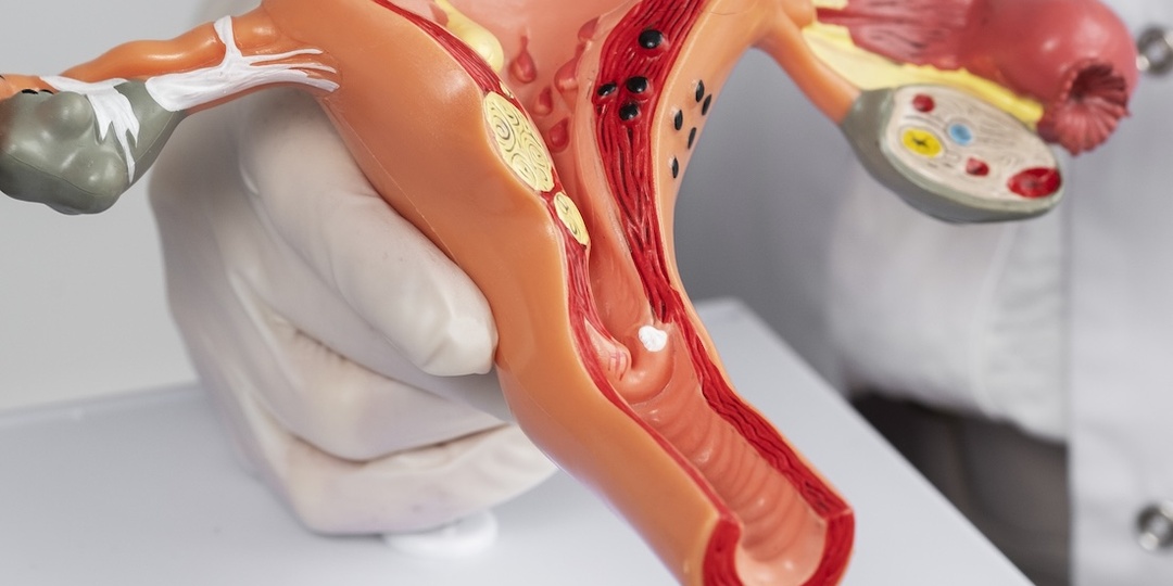 Миома матки: что нельзя делать на самом деле (и почему удаление органа часто хуже самой болезни)