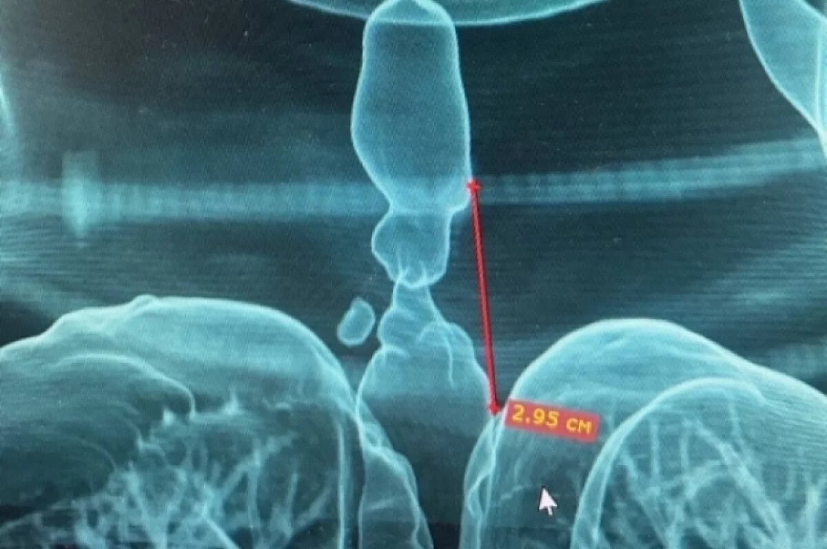    В Ижевске прооперировали женщину со стенозом трахеи, появившимся после ДТП